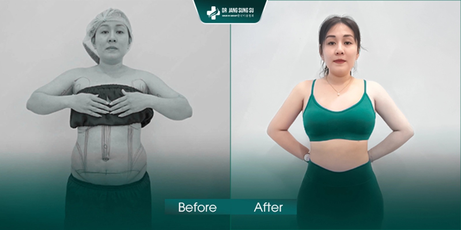Khách hàng giảm 3-5kg mỡ thừa, không để lại sẹo và da chùng, lấy lại vóc dáng hoàn hảo