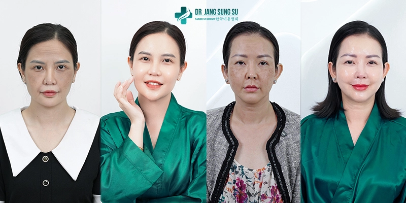 Khách hàng sau liệu trình có làn da săn chắc, sáng mịn, đường nét rõ ràng hơn.