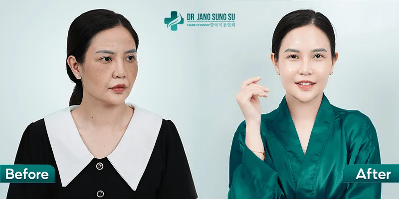 Before & After sau liêụ trình có tại Dr. Jang Sung Su