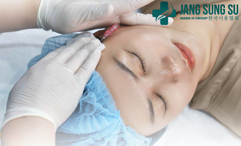 Cấy chỉ Collagen tăng độ đàn hồi và săn chắc cho da Cấy chỉ Collagen tăng độ đàn hồi và săn chắc cho da