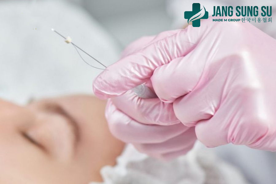 Quy trình cấy chỉ collagen diễn ra như thế nào? Quy trình cấy chỉ collagen diễn ra như thế nào?