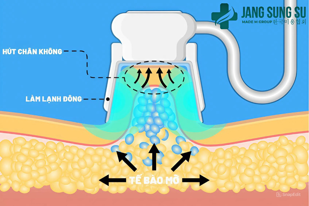 Giảm béo không xâm lấn cần những yếu tố gì? Giảm béo không xâm lấn cần những yếu tố gì?