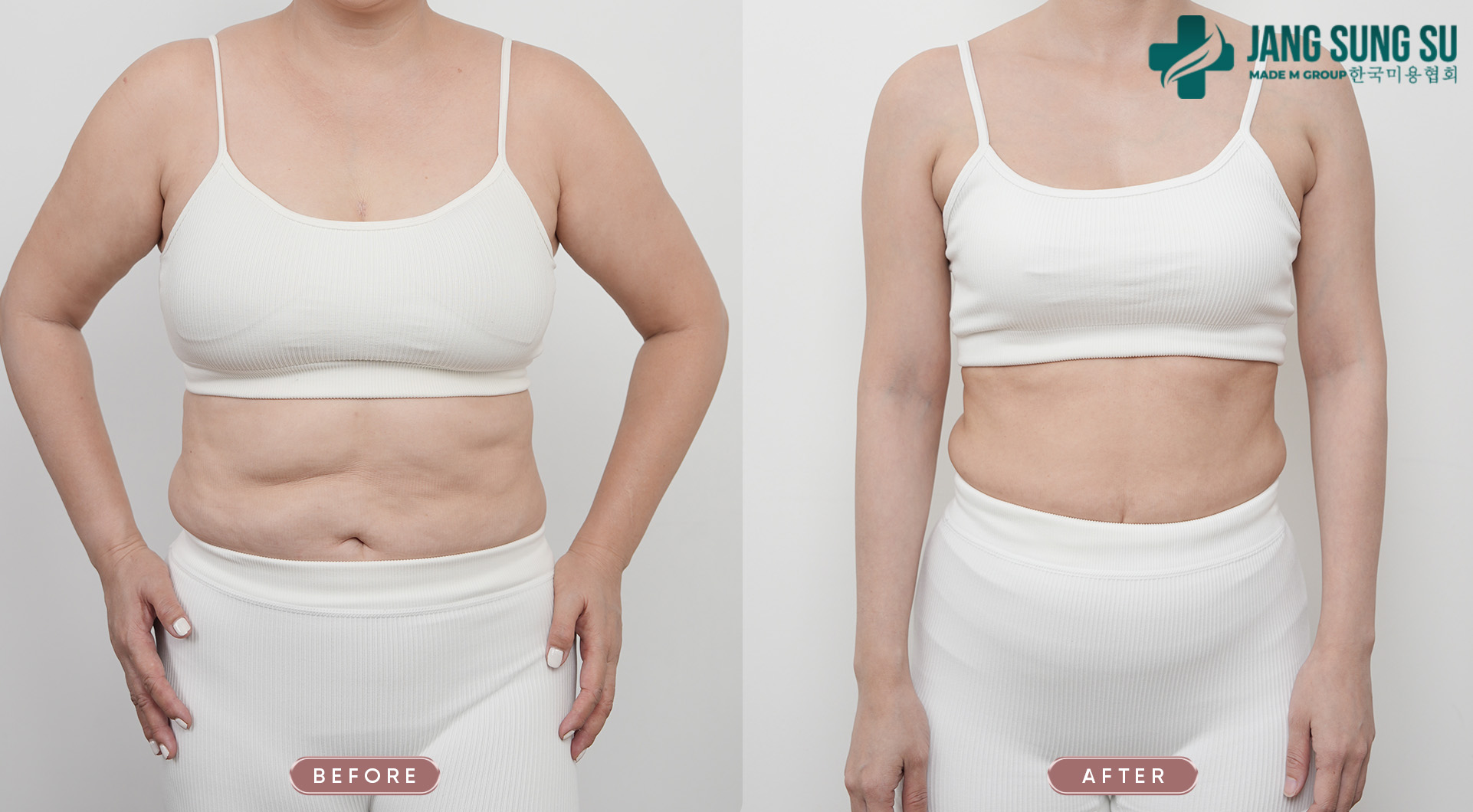 Ưu điểm của thủ thuật giảm béo không xâm lấn Ưu điểm của thủ thuật giảm béo không xâm lấn