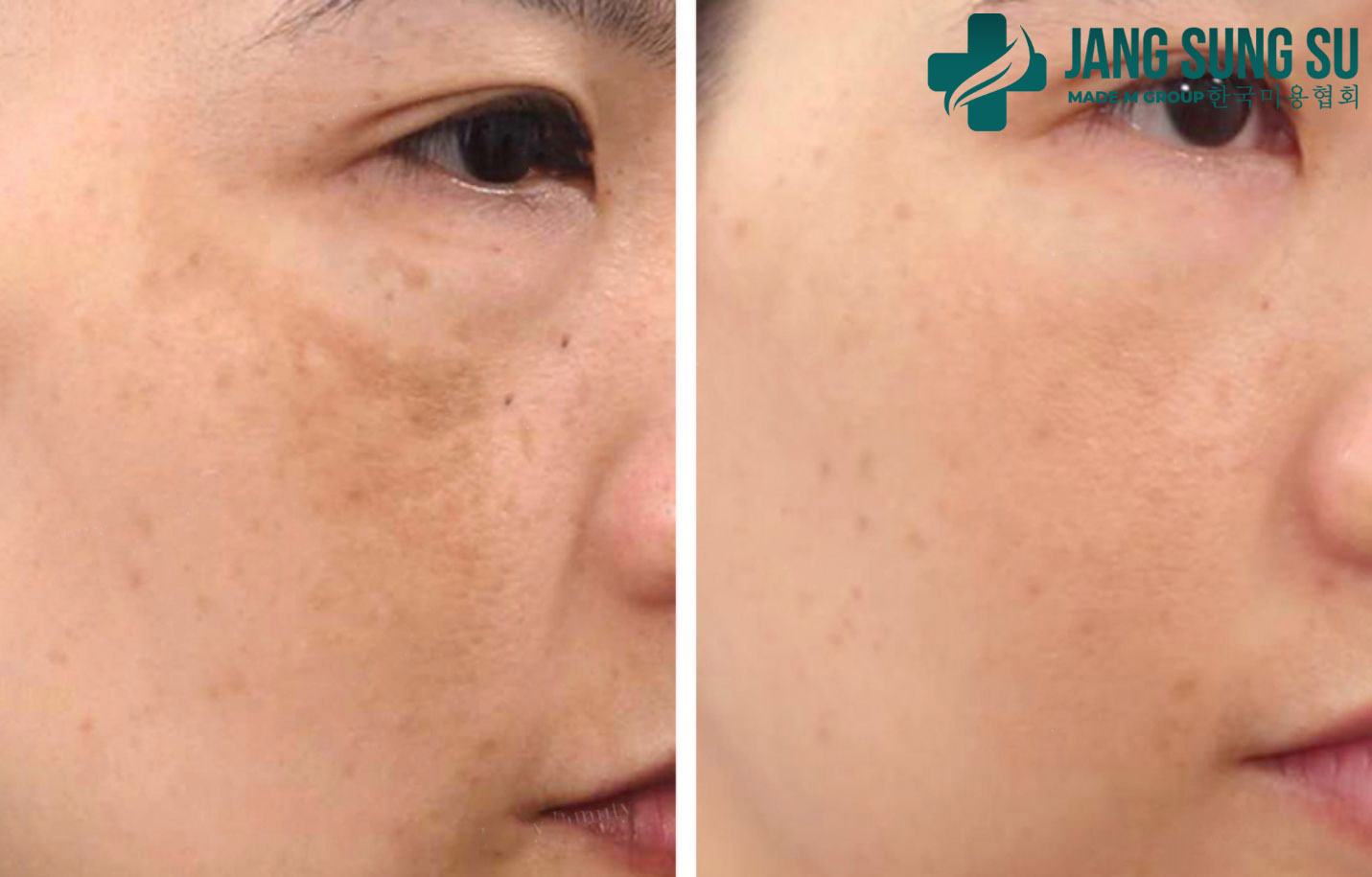 Một liệu trình PRP tại Jang Sung Su Một liệu trình PRP tại Jang Sung Su