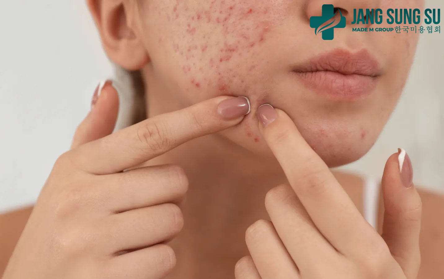 Nguyên nhân chính khiến mụn dễ trở nên nghiêm trọng Nguyên nhân chính khiến mụn dễ trở nên nghiêm trọng